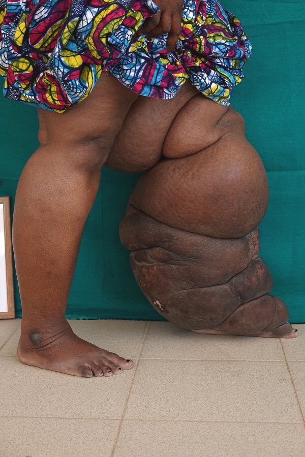 In Cameroon a special form of lymphedema is widespread: Like lymphatic filariasis, podoconiosis causes grotesque swellings particularly in the feet and legs. In addition to physical complaints it incurs a great deal of mental suffering. In Cameroon a special form of lymphedema is widespread: Like lymphatic filariasis, podoconiosis causes grotesque swellings particularly in the feet and legs. In addition to physical complaints it incurs a great deal of mental suffering.